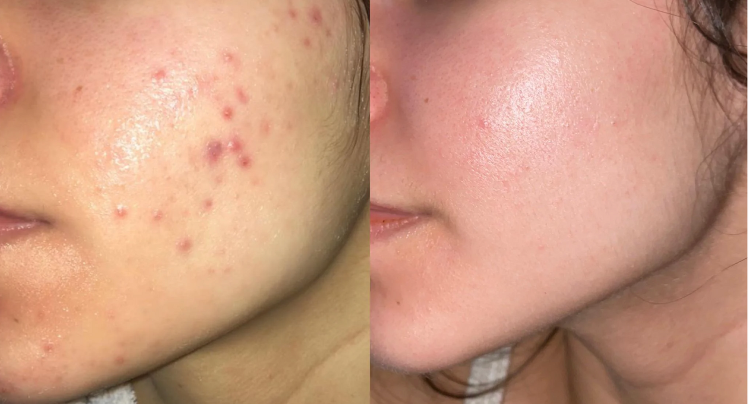 10% Niacinamid + Zink Serum Microneedling geeignet