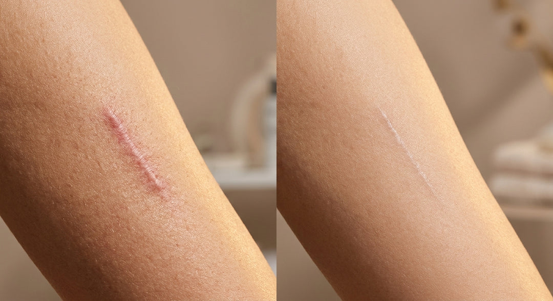 Tiefe Narben und Aknenarben